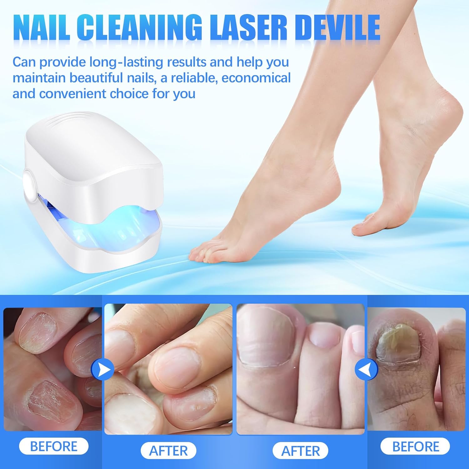 Rechargeable Nail Fungus Treatment for Toenail, Toe Nail Fungal Treatment Nail F - 12915_nail_fungus_cleaning_device