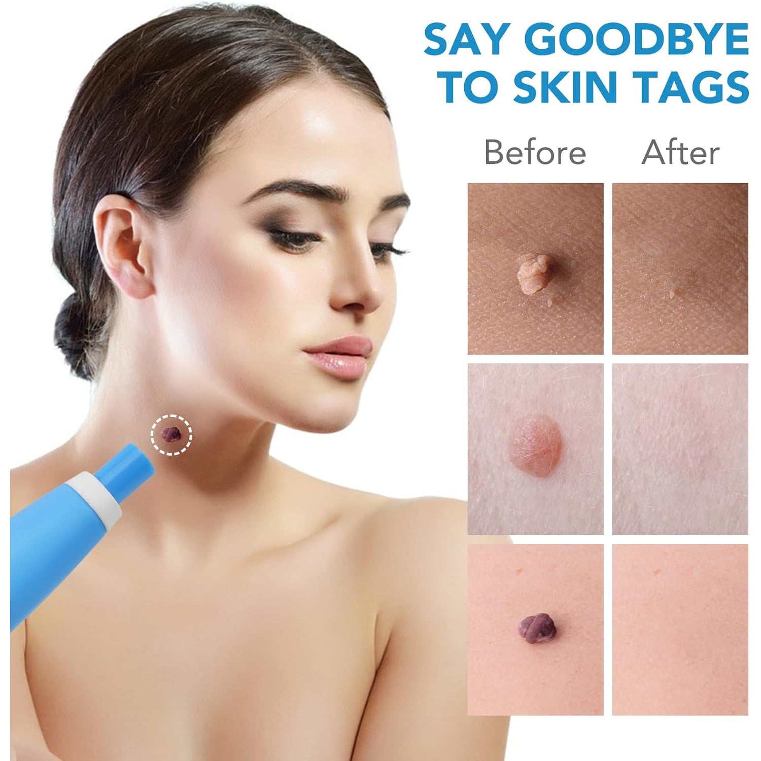 Skin Tag Remover Kit 2 in 1 for Micro to Large (2 mm - 8 mm / 1 Set) - 13000_auto_skin_tag_remover_kit