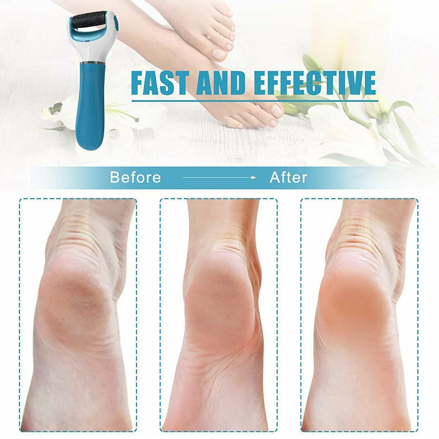 0229 Electronic Dry Foot File Callous Remover For Feet Electric Foot With Roller Hard And Dead Skin- Regular Coarse Baby Smooth Feet In Minutes. For In Home Padicure Foot Care Battery Powered  Usb (Battry Not Included) - Superior eMart